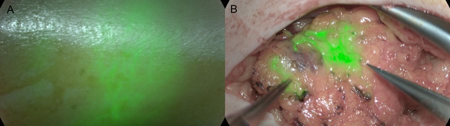 GLOW800 AR fluorescence imaging of a lymph node before incision (A) and during the vascularized lymph node transfer surgery (B). (Courtesy of Dr. C. Becker, American hospital of Paris).