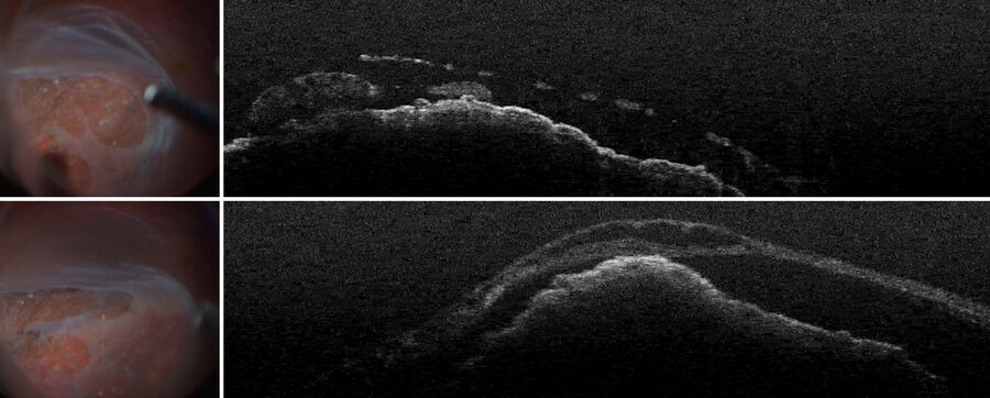 The intraoperative OCT image showed that the retina was not only torn, but that there was also senile retinoschisis. Images provided by Prof. Nikolaos Bechrakis.