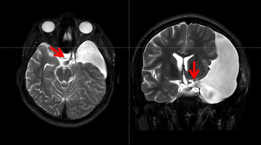 T2 weighted MRI image shows a normal flow from the cyst to the prepontine and interpeduncular cisterns.