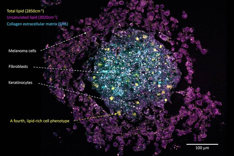 ラベルフリーのSRSイメージングにより、多細胞皮膚がんスフェロイドモデルのコア-シェル構造が明らかになり、予想外の脂質リッチな細胞表現型（単離された明るい黄色の細胞）の出現が明らかになった。 サンプル提供 : Julia Klicks博士、Rüdiger Rudolf教授、マンハイム応用科学大学 、ドイツ