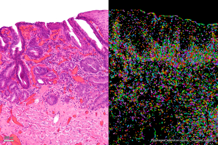 H&E stained micrograph of an intramucosal esophageal adenocarcinoma (left) enhanced with Aivia’s Pixel Classifier (right) 