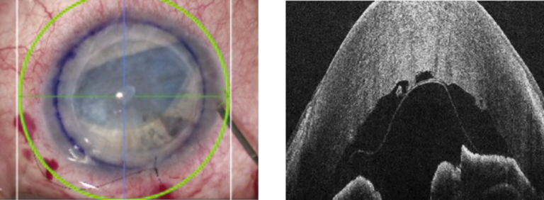 DMEK 手術中の顕微鏡画像(左) とEnFocus OCTで補足 (右) ドナー膜のスクロール方向を示している。 左の顕微鏡画像は、ドイツのデュッセルドルフ大学病院眼科のGerd Geerling、MD、PhD、FEBOの協力により提供