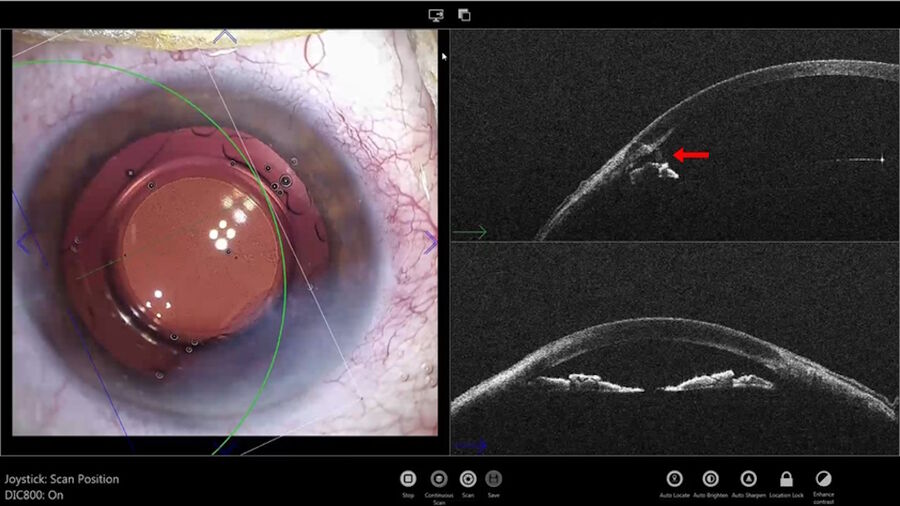 Figure 2: Little residual fragment in front of the secondary incision.