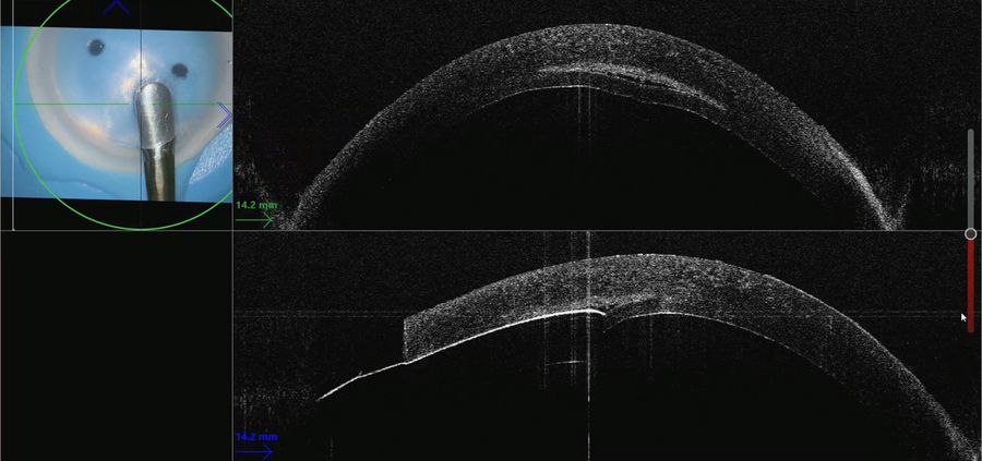 The intraoperative OCT image showed the lamellar splitter defining the plane. Images provided by Mr. David Anderson.