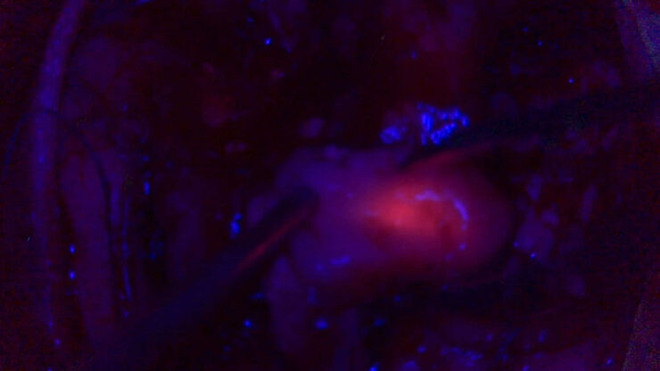 Tumor resection leveraging 5-ALA fluorescence. Image courtesy of Dr. Carla Reizinho. Tumor resection leveraging 5-ALA fluorescence. Image courtesy of Dr. Carla Reizinho.