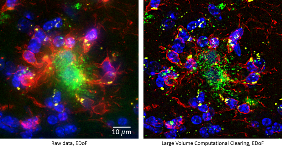 Longitudinal mouse brain section of the hippocampus showing an amyloid plaque.