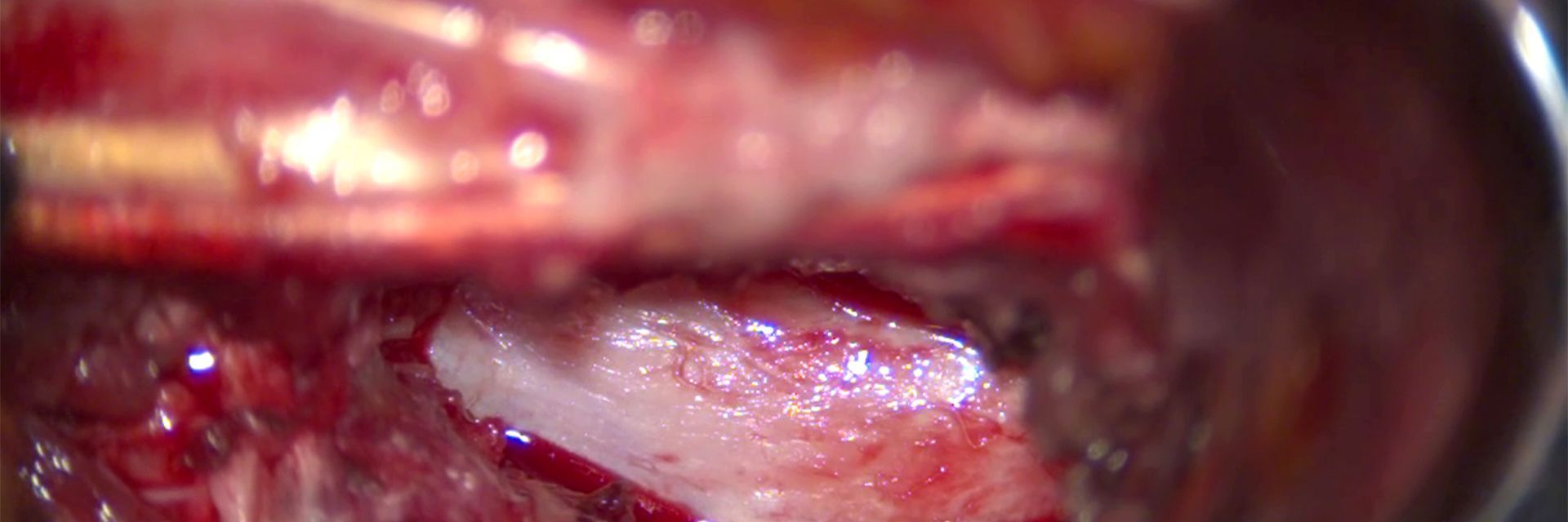 Spine surgery using the ARveo 8 surgical microscope. Dr. Alfieri, MD, Chief Physician and Head of Clinic for Neurosurgery & Spine Surgery