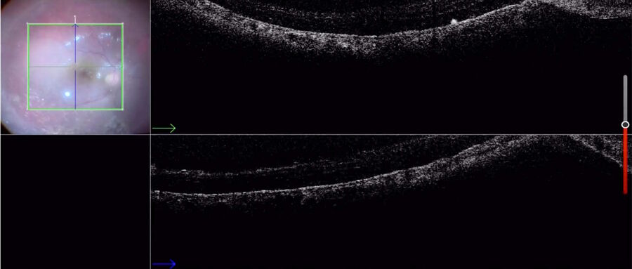 Vitrectomy for retinal detachment with use of PFCL shows attachment of the macula with PFCL.