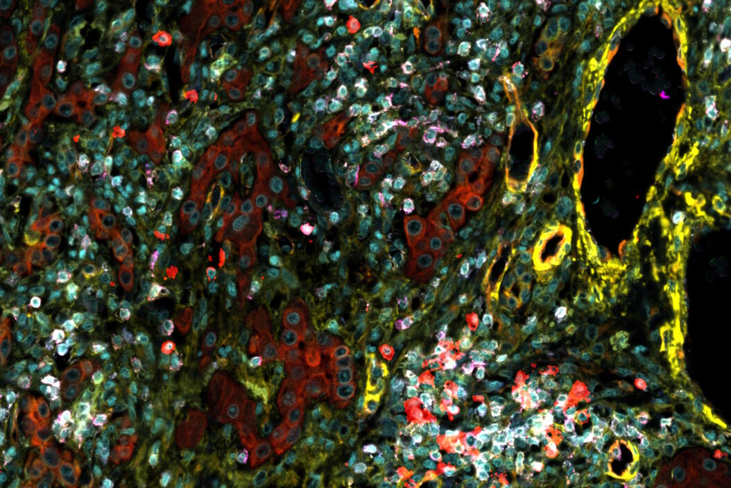 [Translate to chinese:] Hepatocellular Carcinoma with 13 biomarkers shown – Beta-Catenin, CD3D, CD4, CD8a, CD31, CD44, CD163, DAPI, PanCK, PCK26, PD1, SMA, and Vimentin. Hepatocellular_Carcinoma_13_Markers_Zoom2.jpg