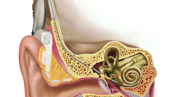 Cochlea implant. Illustration: © MED-EL. Cochlea implant. Illustration: © MED-EL.