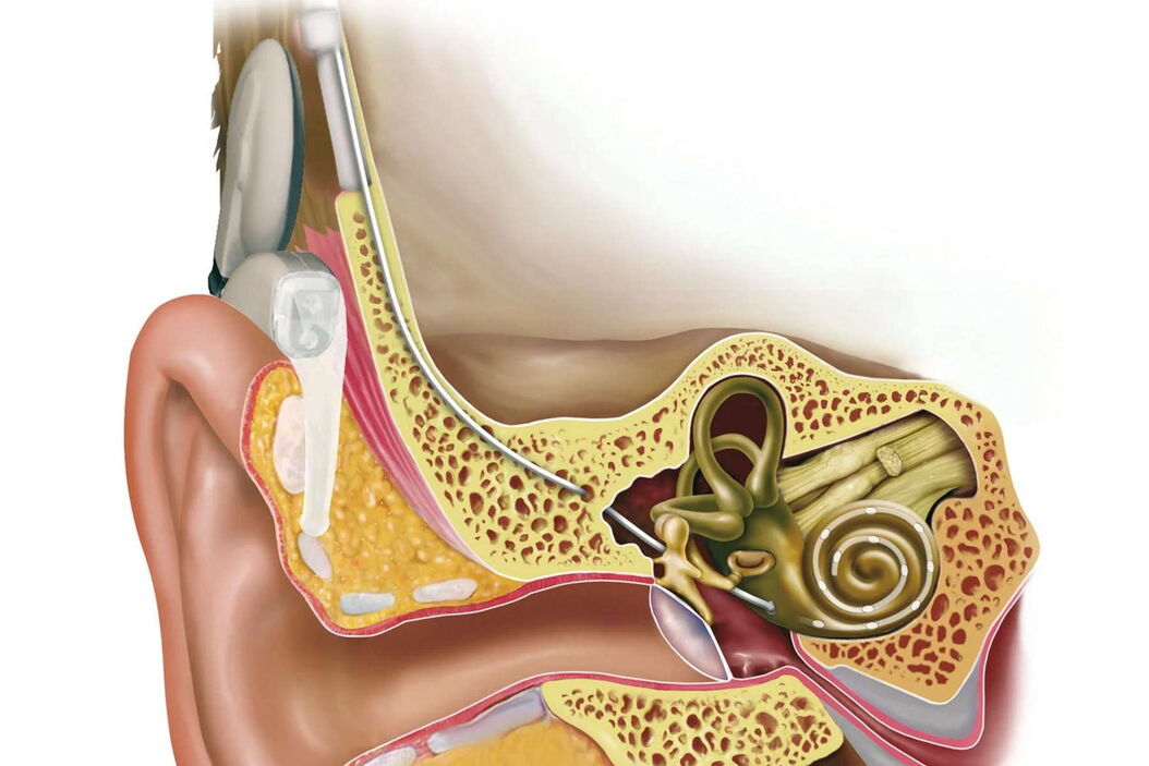 Cochlea implant. Illustration: © MED-EL. Cochlea_implant_Illustration___MED-EL.jpg