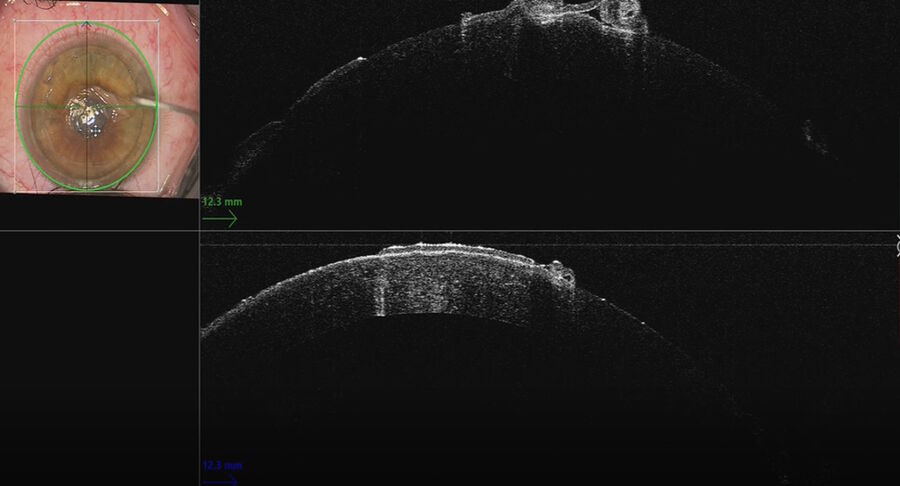 The intraoperative OCT showed the scrolls of epithelium leaving the basement membrane. Images provided by Mr. David Anderson. The intraoperative OCT showed the scrolls of epithelium leaving the basement membrane. Images provided by Mr. David Anderson.