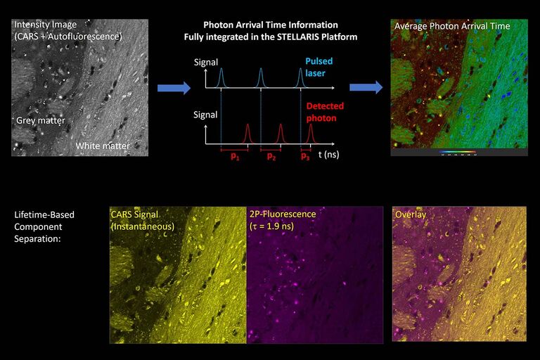 En haut à gauche : Image au microscope CARS des lipides dans un tissu cérébral, montrant les régions riches en lipides de la matière blanche et de la matière grise. En haut à droite : L’image de temps d’arrivée moyen des photons révèle des temps d’arrivée plus courts de la matière blanche riche en lipides et des temps d’arrivée plus longs de la matière grise. Ce résultat indique que les signaux CARS instantanés sont accompagnés de signaux d’autofluorescence à 2-photons avec un temps de vie limité. Ligne du bas : Séparation des signaux CARS instantanés et des signaux d’autofluorescence basée sur le temps de vie avec un temps d’arrivée moyen de 1,9 ns. Droite : Image superposée.