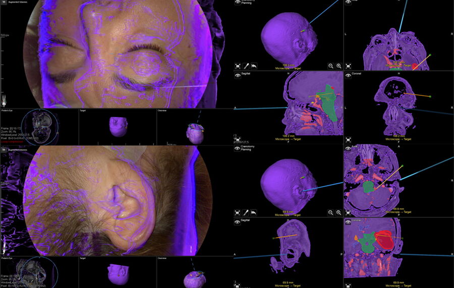 Registration accuracy check. Image courtesy of Prof. Philippe Bijlenga. 