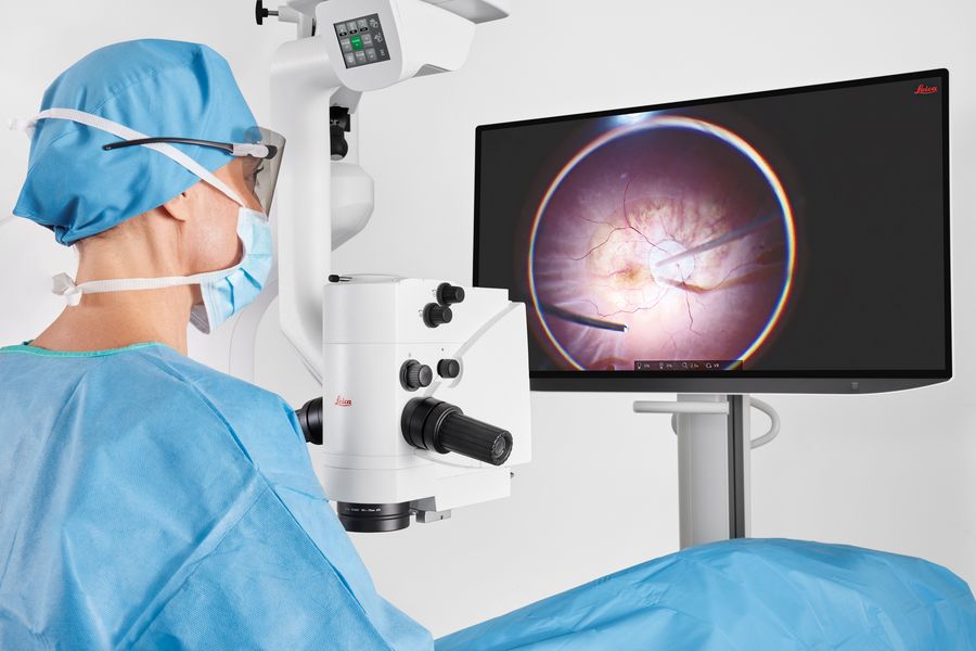 Ophthalmic surgery performed using a Proveo 8x 3D digital microscope, showing a high‑resolution native 4K surgical image displayed in real time to support detailed visualization during heads‑up surgery. 