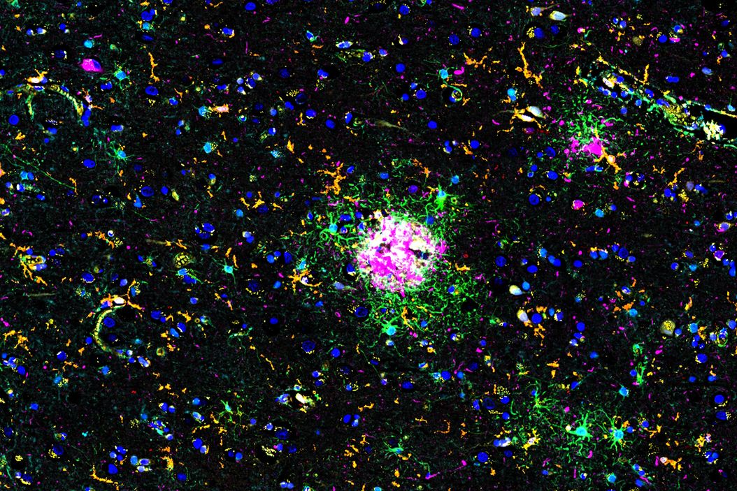 Multiplexed Cell DIVE imaging of Adult Human Alzheimer’s Brain Tissue labelled with 15 antibodies targeted towards markers specific to astrocytes (GFAP, S100B), microglia (TMEM119, IBA1), and Alzheimer’s-associated markers (β-amyloid and p-Tau217). Adult_Human_Alzheimers_Brain_Tissue_labelled_with_15_antibodies.jpg