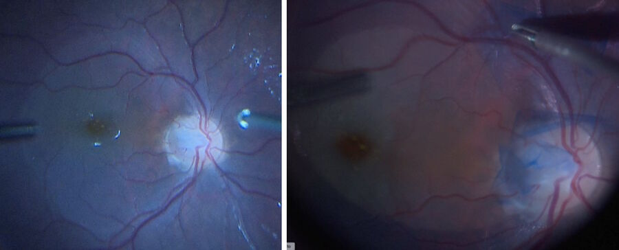 The ILM was peeled with a 25g instrument after putting ILM dye. Images provided by Prof. Nikolaos Bechrakis.