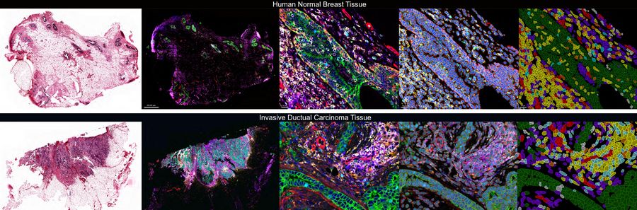 Cell DIVE multiplexed imaging and Aivia analysis to understand the molecular architecture of breast cancer. 