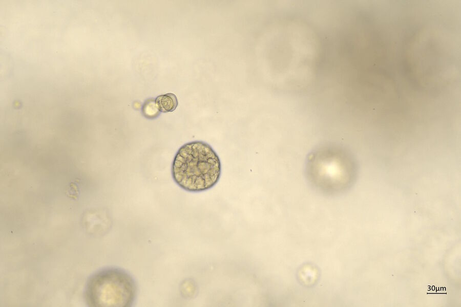 Figure 5: 10x magnification of organoids cluster taken on Mateo TL.Cell type: esophageal squamous carcinoma; scale  bar 30µm.  Courtesy of bioGenous, China. 