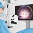Retina surgeon performing a 3D retina surgery using the Proveo 8x 3D digital microscope and viewing the procedure on a 3D monitor