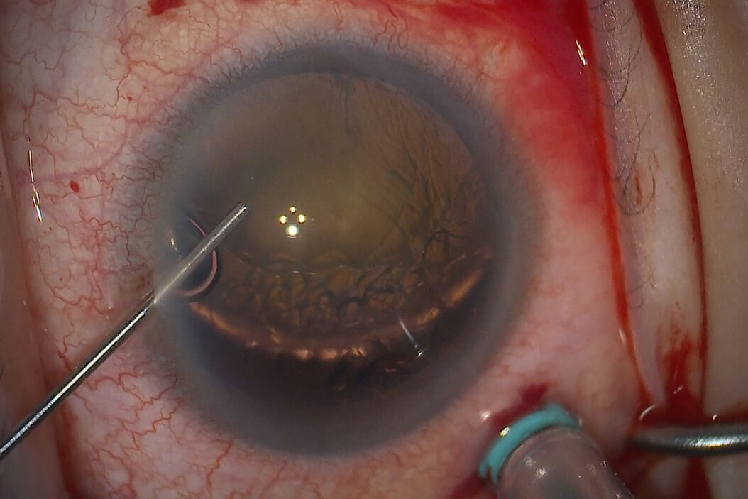 Applying dispersive viscoelastic to coat the anterior chamber. Image courtesy of Arsham Sheybani, MD, Washington University School of Medicine. Applying_dispersive_viscoelastic_to_coat_the_anterior_chamber.jpg