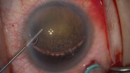 Applying dispersive viscoelastic to coat the anterior chamber. Image courtesy of Arsham Sheybani, MD, Washington University School of Medicine.