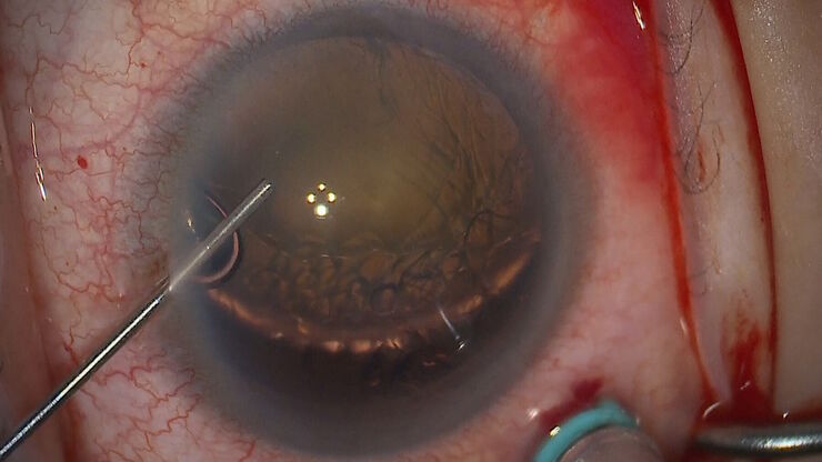 Applying dispersive viscoelastic to coat the anterior chamber. Image courtesy of Arsham Sheybani, MD, Washington University School of Medicine.