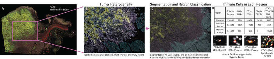 Figure 1: A:Metabolic and hypoxic, apoptotic, EMT, and immune cell status spatially within the tumor. B:Hypoxia marker Glut1, and two PanCK biomarkers separate cancer cells with increased glucose uptake, a cancer hallmark. C: Following segmentation using the full set of 30 biomarkers, a small subset of biomarkers was used to classify and spatially characterize heterogeneous regions of the tumor. D: Quantifying immune contribution across regions, normoxic tumor and normal pancreas compared to hypoxic tumor regions, there is an overall reduction in lymphocytes, and increased CD45+ populations, even though the total cells in all regions are similar.