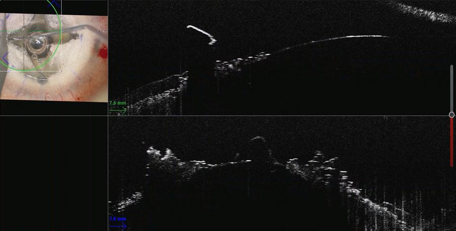 A little bubble in the anterior chamber was observed on the intraoperative OCT. Images provided by Mr. David Anderson.