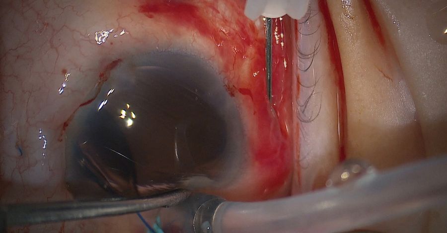 The light reflex of the pupil was examined with the eye in an ortho position. The needle was then directed in the opposite direction to capture the trailing haptic. Image courtesy of Arsham Sheybani, MD, Washington University School of Medicine.