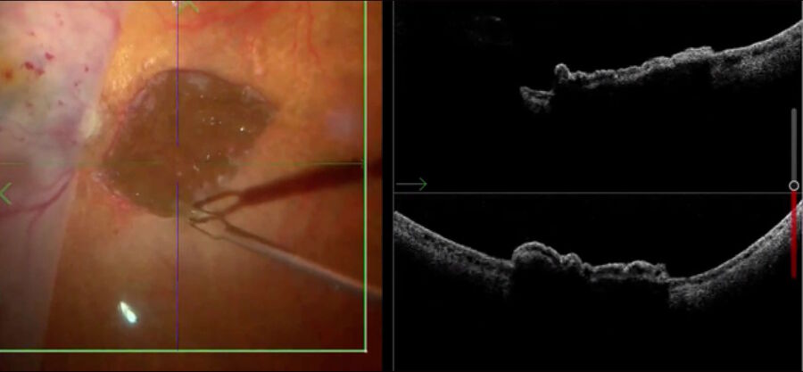 [Translate to chinese:] Intraoperative OCT view of a choroidal transplant well positioned over the choroid. The retina is not yet reattached.