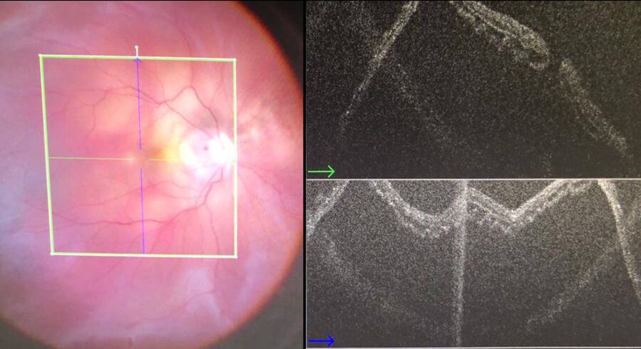 Retinal detachment with a macular hole in a highly myopic eye. Intraoperative OCT confirms the presence and location of the macular hole.