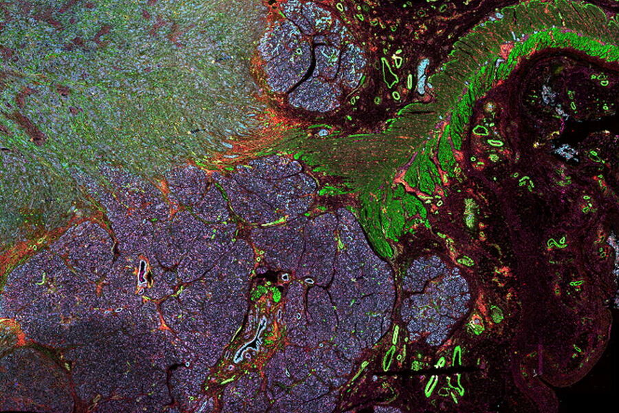Secção do tecido adenocarcinoma ductal pancreático imitado com Mergulho Celular. 