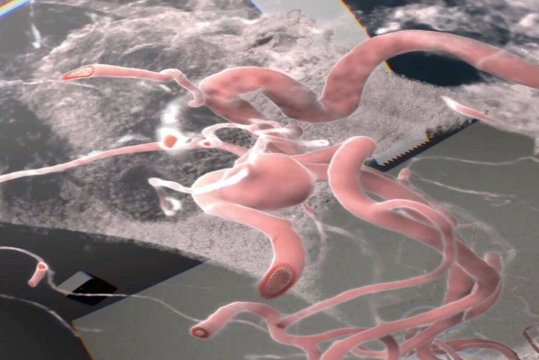 Analysis of an aneurysm with Virtual Reality. Image courtesy of Prof. Raphael Guzman. Analysis_of_an_aneurysm_with_Virtual_Reality_Teaser.jpg
