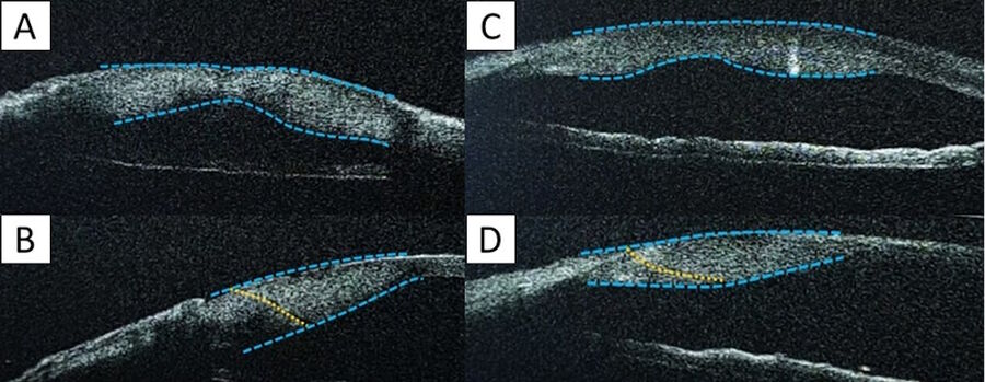 Figure 6: When suturing a non-sealed incision, the incision’s path becomes invisible. The corneal anterior face curvature remains almost unchanged. Then, the modification of curvature mainly impacts the posterior face, which becomes a double bump.