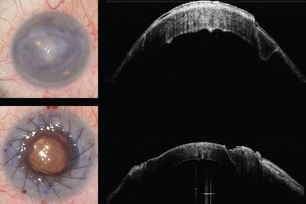 Keratoplasty of pathologic cornea Pathologic_cornea.jpg