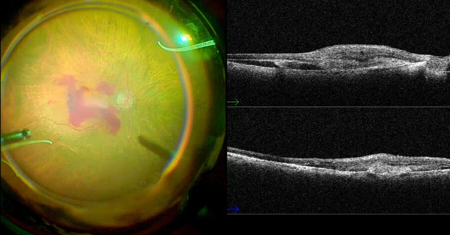 Fig. 1: Intraoperative 2D photograph of the NGENUITY® monitor showing an OCT image (EnFocus, Leica Microsystems) captured during the procedure. This image has been captured in the OR as a screen capture from one of the monitors.