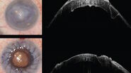 Microscope view (left). The intraoperative OCT images (right) allowed Prof. Bechrakis to see exactly where the previous scars were to avoid the area where the previous trephination was performed. Images provided by Prof. Nikolaos Bechrakis.