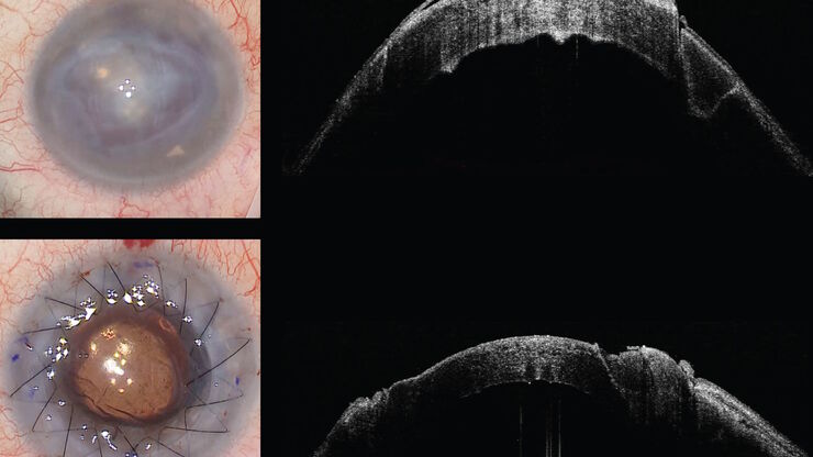 Microscope view (left). The intraoperative OCT images (right) allowed Prof. Bechrakis to see exactly where the previous scars were to avoid the area where the previous trephination was performed. Images provided by Prof. Nikolaos Bechrakis. Microscope view (left). The intraoperative OCT images (right) allowed Prof. Bechrakis to see exactly where the previous scars were to avoid the area where the previous trephination was performed. Images provided by Prof. Nikolaos Bechrakis.