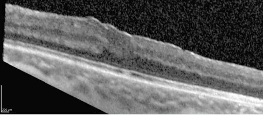 Post-operative scan depicts improved foveal architecture and closed lamellar macular hole. Image courtesy of Robert A. Sisk, MD, FACS, Cincinnati Eye Institute.