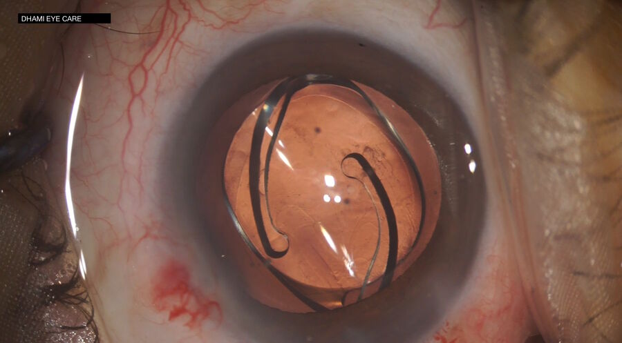 Figure 2: With the M822 microscope, Dr. Dhami enjoys optimal visualization and improves his surgical precision. Image courtesy of Dr. Abhinav Dhami.