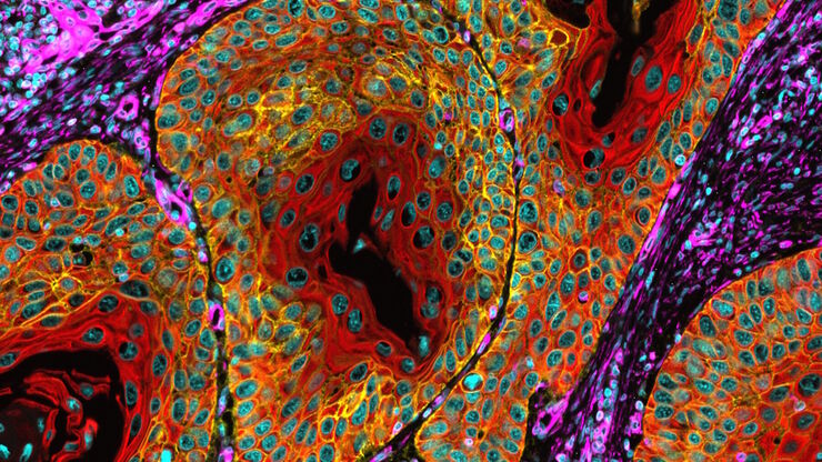 Esophageal tissue with a squamous cell carcinoma labelled with the 4 biomarkers PanCk, DAPI, NaKATPase, and Vimentin. Esophageal tissue with a squamous cell carcinoma labelled with the 4 biomarkers PanCk, DAPI, NaKATPase, and Vimentin.