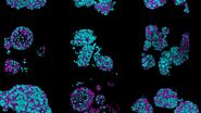 Patient-derived neuroendocrine tumor organoids labelled with DAPI (cyan), beta-catenin (yellow) and phalloidin (magenta), acquired using Viventis SCAPE; scale bar 50 µm. Sample courtesy of Marina Cuenca and Heleen Jungen, Dayton lab, EMBL Barcelona.