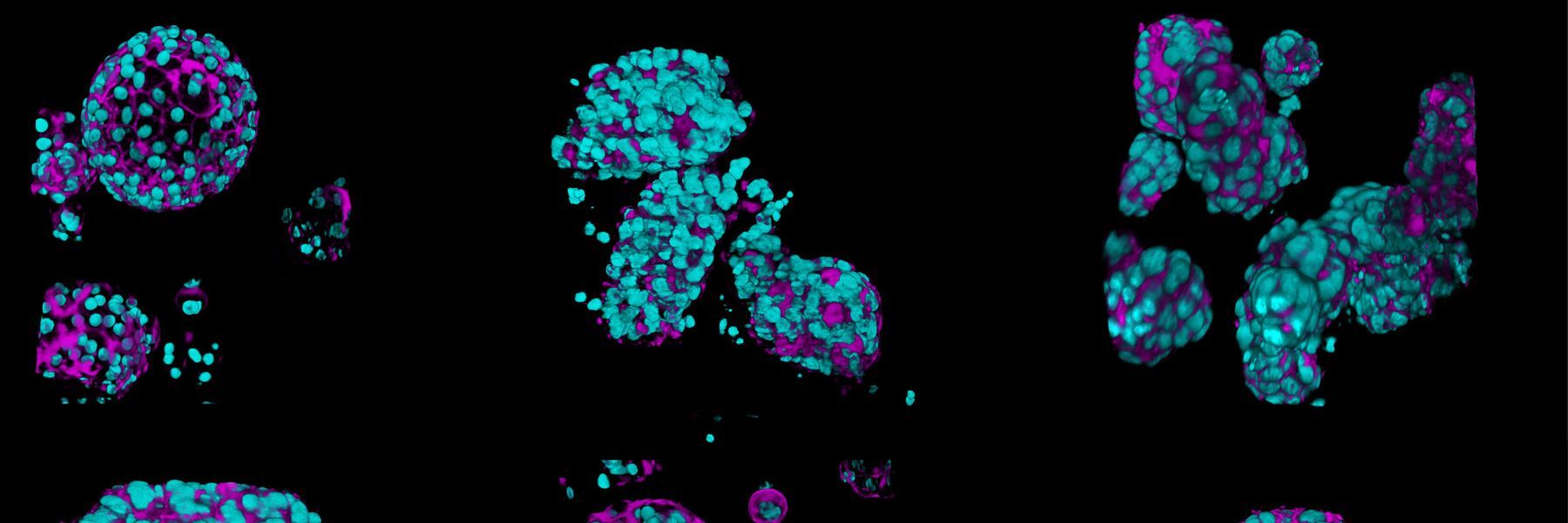 Patient-derived neuroendocrine tumor organoids labelled with DAPI (cyan), beta-catenin (yellow) and phalloidin (magenta), acquired using Viventis SCAPE; scale bar 50 µm. Sample courtesy of Marina Cuenca and Heleen Jungen, Dayton lab, EMBL Barcelona.