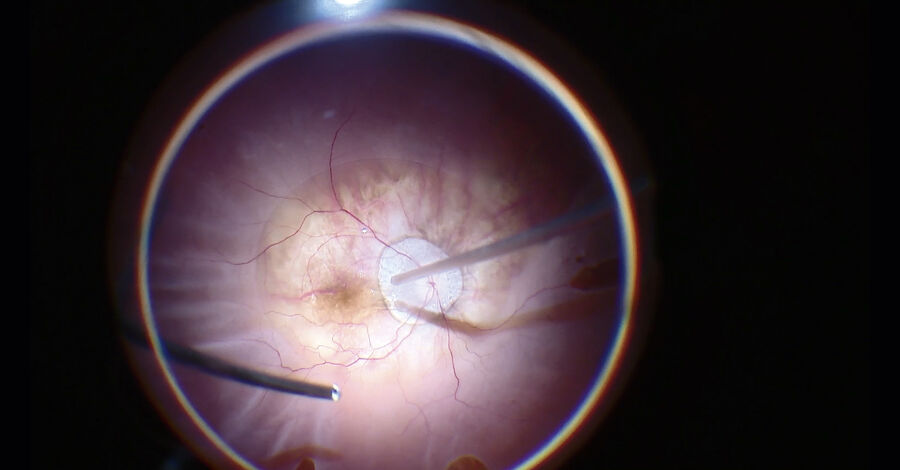 CENTOGENE Microscope Solutions for Retina Surgery provide great depth of field and easy-to-use wide-angle viewing systems