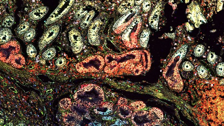 Pancreatic Ductal Adenocarcinoma with 11 Apoptosis biomarkers shown – BAK, BAX, BCL2, BCLXL, Caspase9, CIAP1, NaKATPase, PCK26, SMAC, Vimentin, and XIAP.