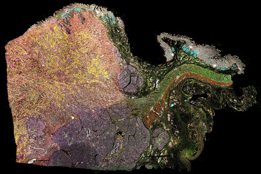 Pancreatic ductal adenocarcinoma tissue section imaged with Cell DIVE showing 30 biomarkers Pancreatic_ductal_adenocarcinoma_Cell_DIVE_30_biomarkers.jpg