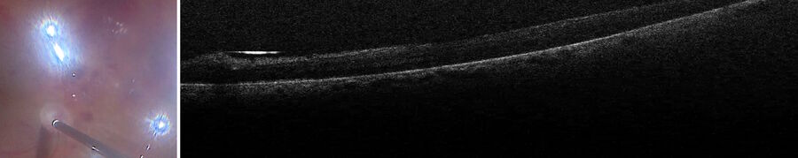 术中使用 OCT 可以看到视网膜下有多少积液，并检查剥离后是否有残留的薄膜。图片由 Nikolaos Bechrakis 教授提供。