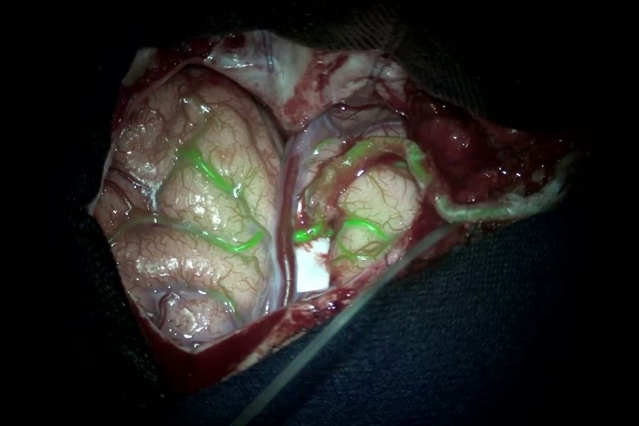 GLOW800 augmented reality fluorescence in moyamoya disease treatment.