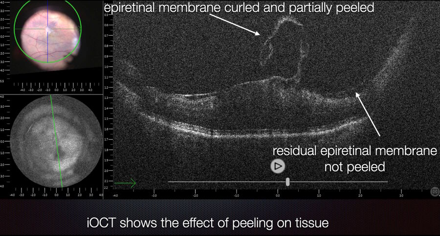 Checking the completeness of epiretinal membrane peeling with intraoperative OCT.